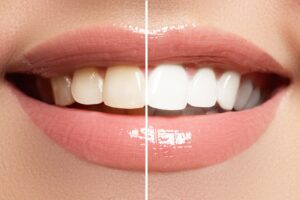 Read more about the article The Benefits of Zoom Teeth Whitening at Your Local Dentist Office