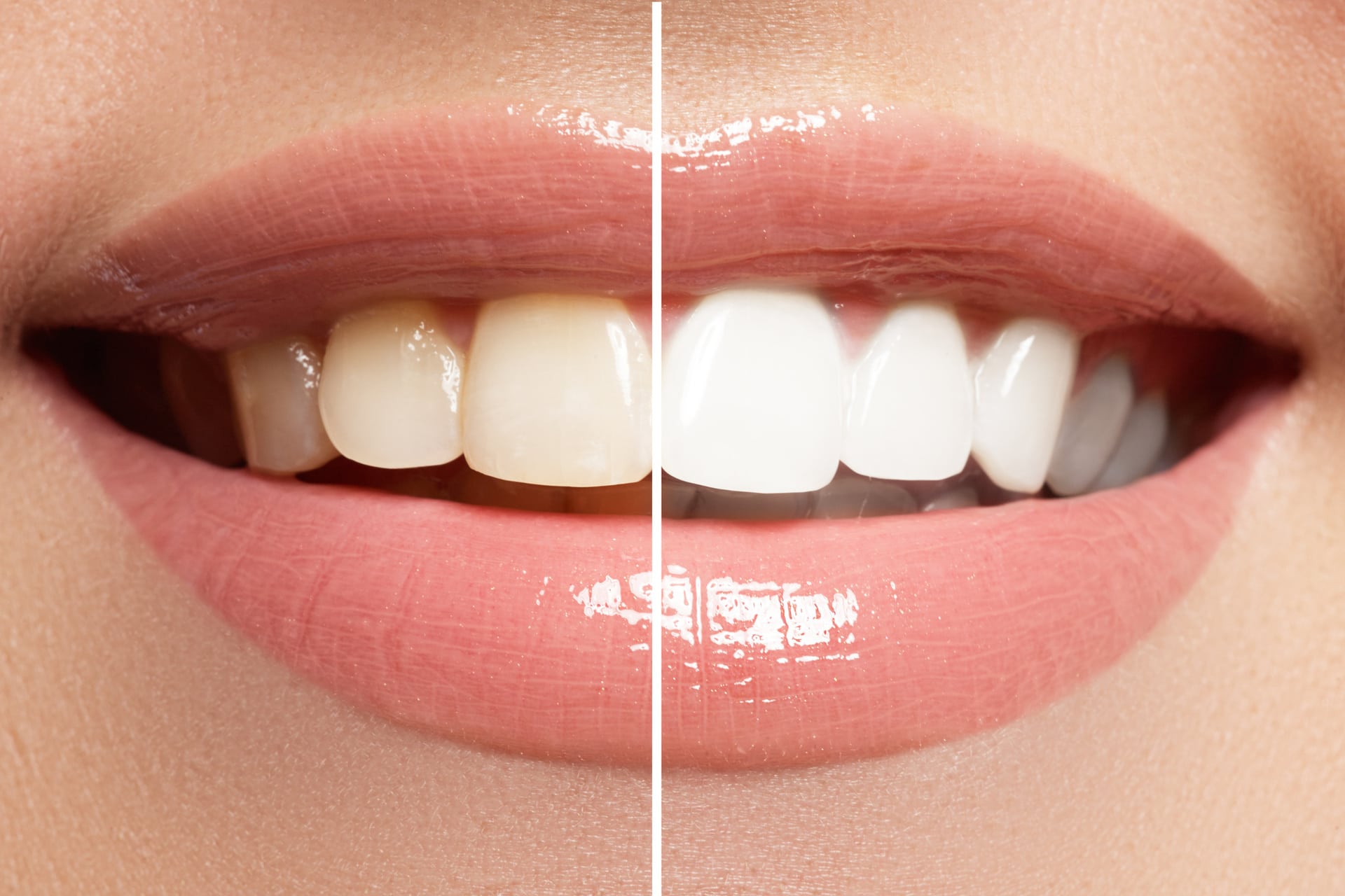 You are currently viewing The Benefits of Zoom Teeth Whitening at Your Local Dentist Office