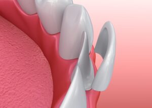Read more about the article What Are Dental Veneers? A Brief Guide